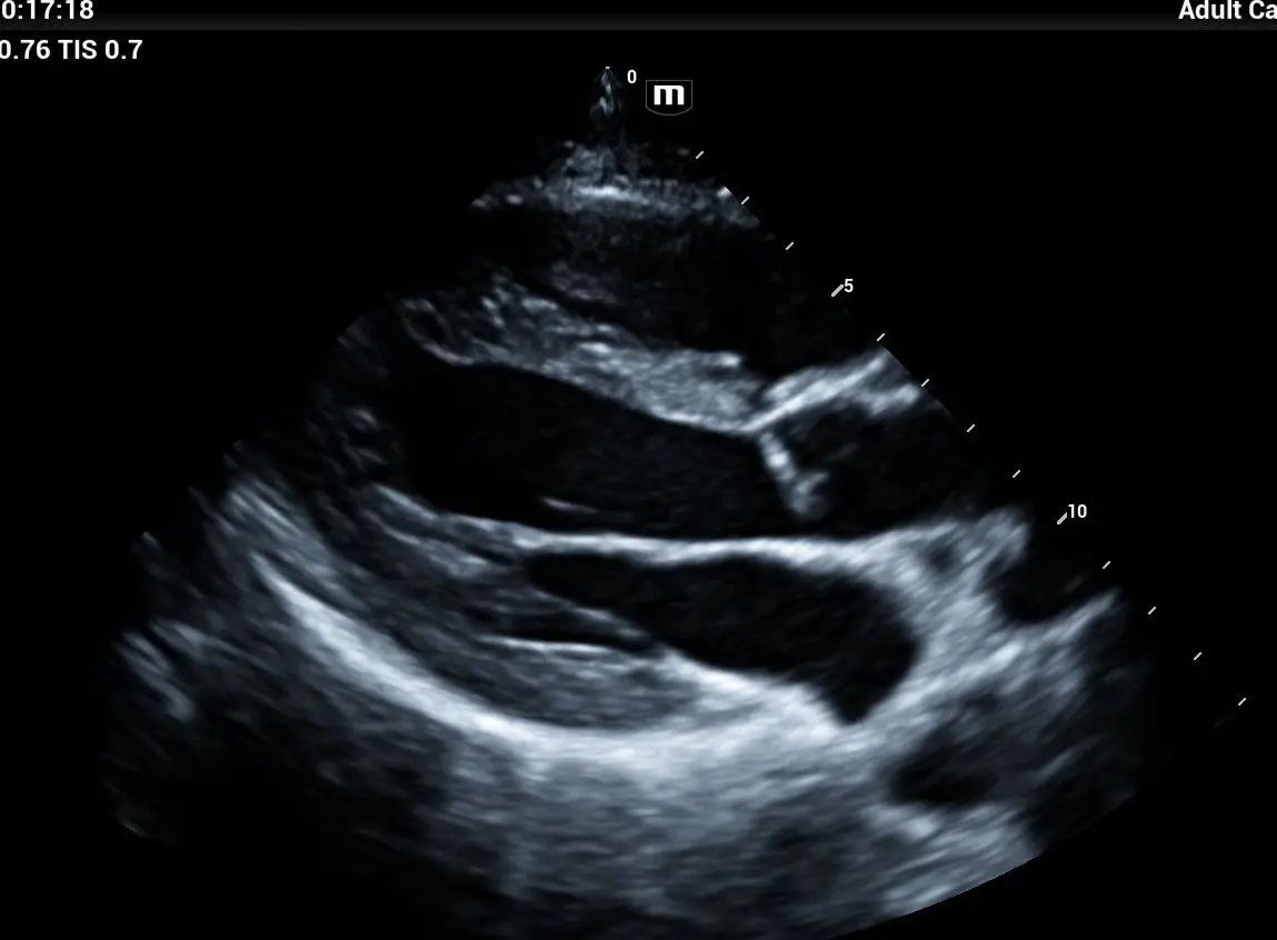 Ecocardiograma 1