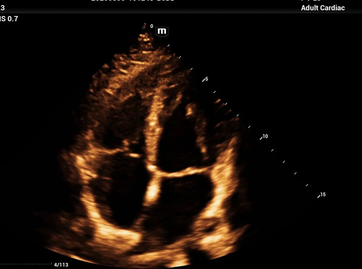 Ecocardiograma 3